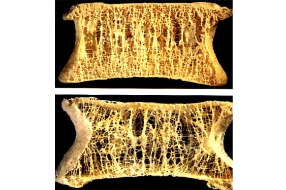 Zdravá kost (nahoře) a kost postižená osteoporózou (dole)