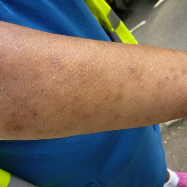 Štípance na ruce Marie Hučkové | foto: Tomáš Mařas,  Český rozhlas