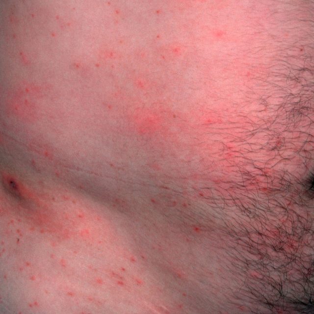 Svrab | foto: Profimedia