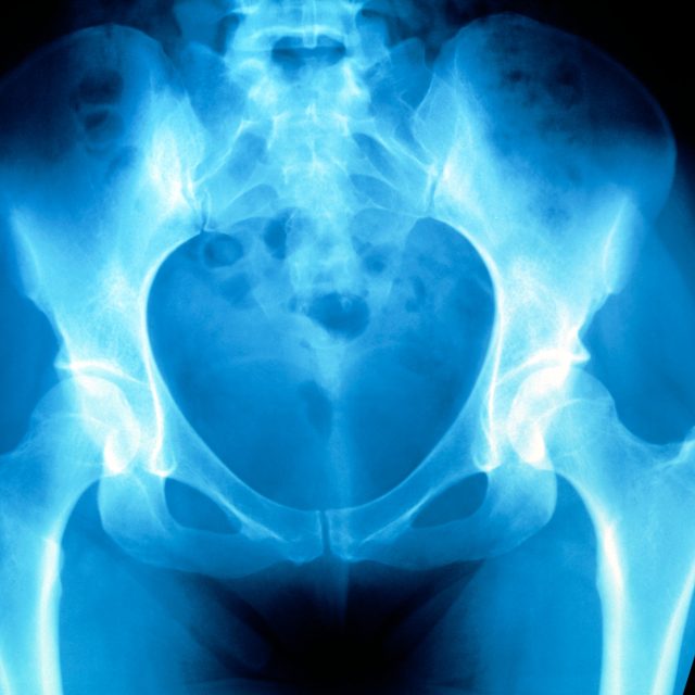 Rentgenový snímek ženské pánve | foto: Profimedia