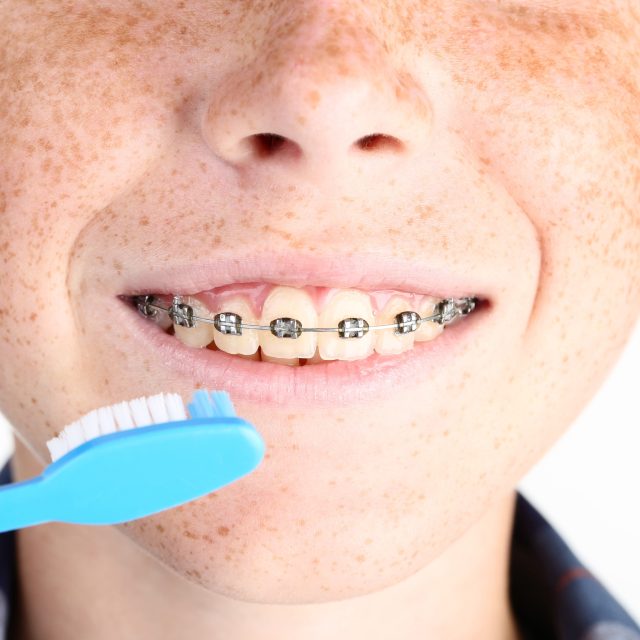 Správná a častá zubní hygiena je při používání rovnátek klíčová | foto: Profimedia