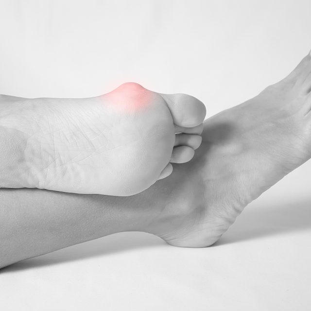 Hallux valgus,  vbočený palec | foto: Shutterstock