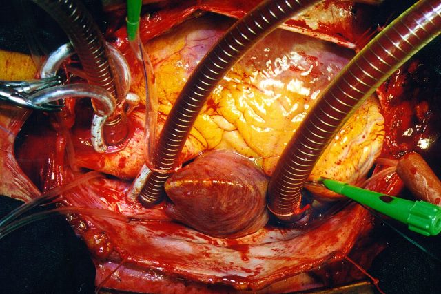 Operace srdce | foto: Databáze Kardiochirurgické kliniky 
