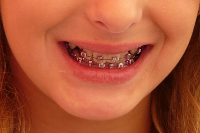 Zubní rovnátka: zdravotní pomůcka,  nebo módní doplněk? | foto: Fotobanka stock.xchng