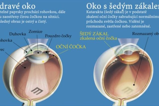 Šedý zákal | foto:  Klinika oční a estetické chirurgie 
