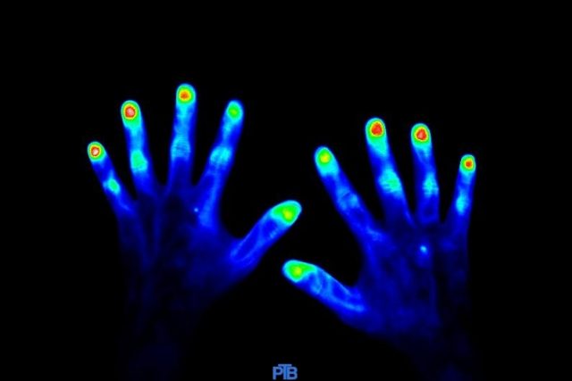 Zdravé ruce  (45 vteřin po aplikaci kontrastního barviva) | foto: Physikalisch-Technische Bundesanstalt