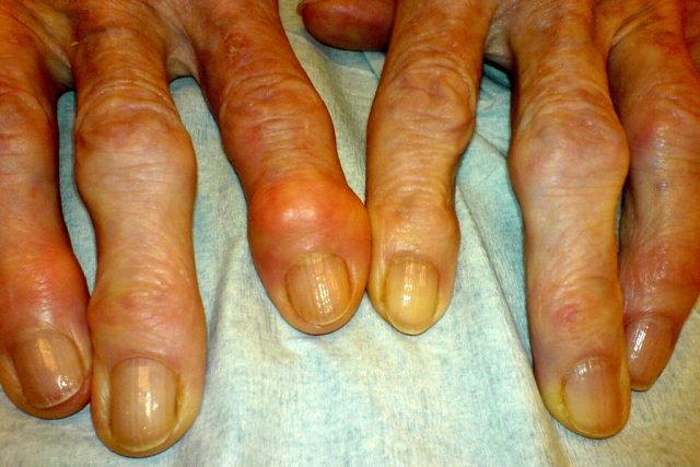 Artróza - deformity kloubů na prstech  (Heberdenovy uzly) | foto: licence Creative Commons Attribution 3.0 Unported,   Uživatel: Drahreg01