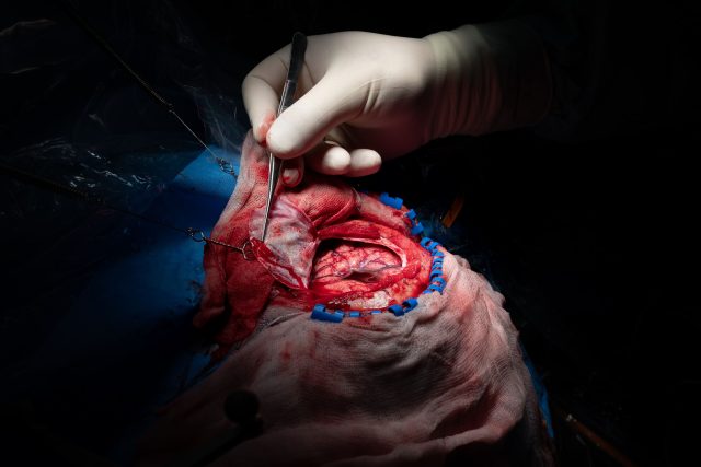 Operace mozku,  Neurochirurgická klinika FN HK | foto: Jiřina Šmídová,  Český rozhlas