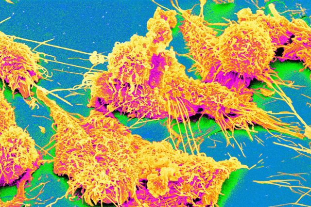 Obarvené buňky rakoviny prsu pod elektronovým mikroskopem | foto: Profimedia